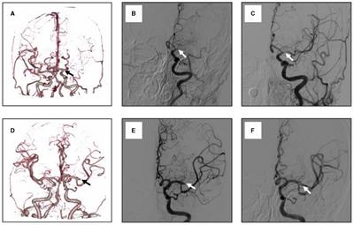 Clot patterns determined by DSA and CTA can help predict intracranial atherosclerotic stenosis in acute ischemic stroke patients